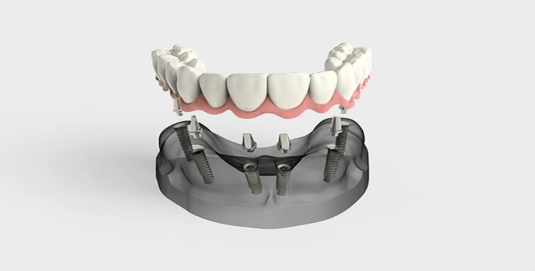 Hawkesbury Dentist All-on-4 Implants