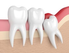 Dentist Wisdom Teeth Dental Services in Hawkesbury
