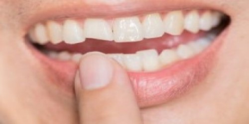 Dental Bonding Hawkesbury | Teeth Bonding Hawkesbury