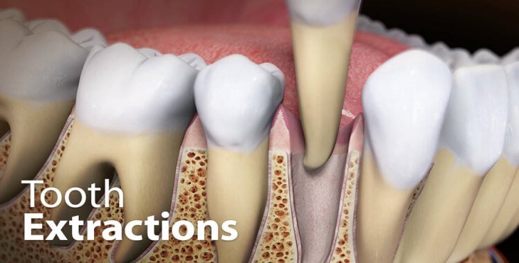Dentist Extractions Dental Services in Hawkesbury
