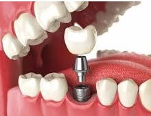 Dentist Implants in Hawkesbury
