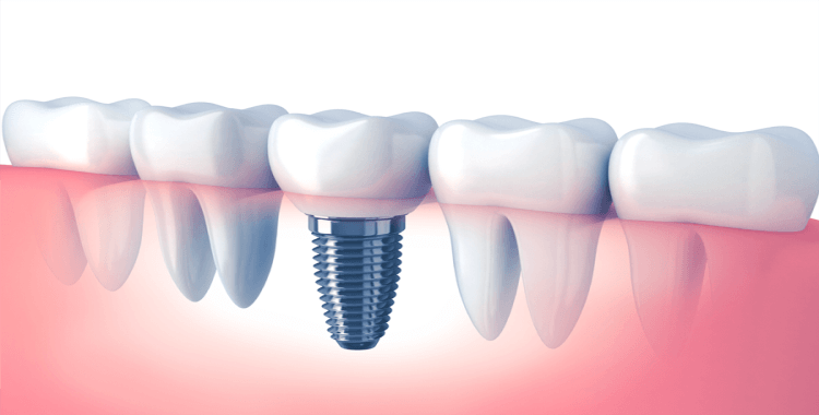 Dentist Implant Dental Services in Hawkesbury