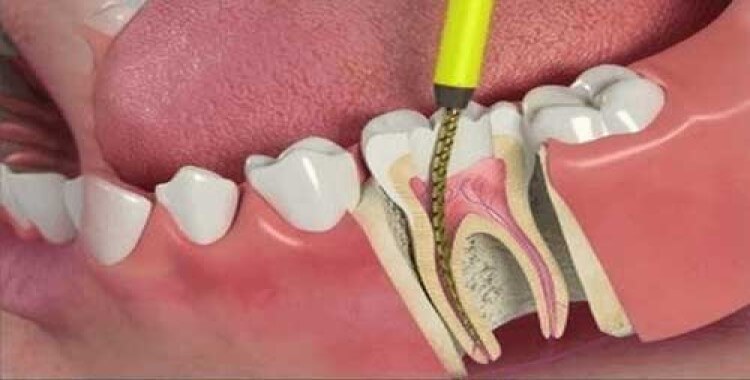 Dentist Root Canal Dental Services in Hawkesbury
