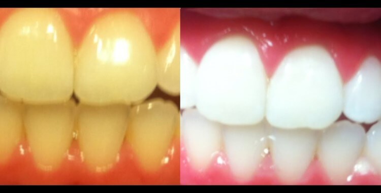 Dentist Teeth Whitening Dental Services in Hawkesbury